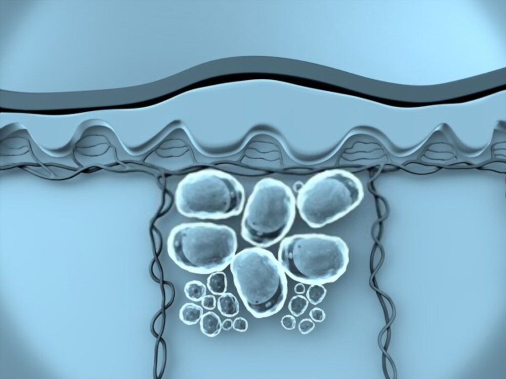 xanthelasma cryo therapy 2