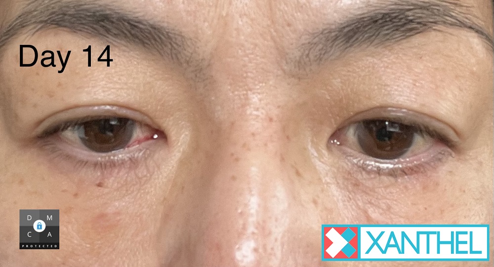 xanthelasma removal 2