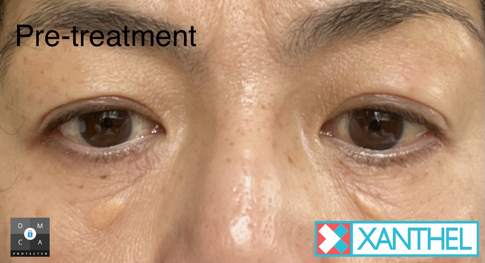 xanthelasma removal 1