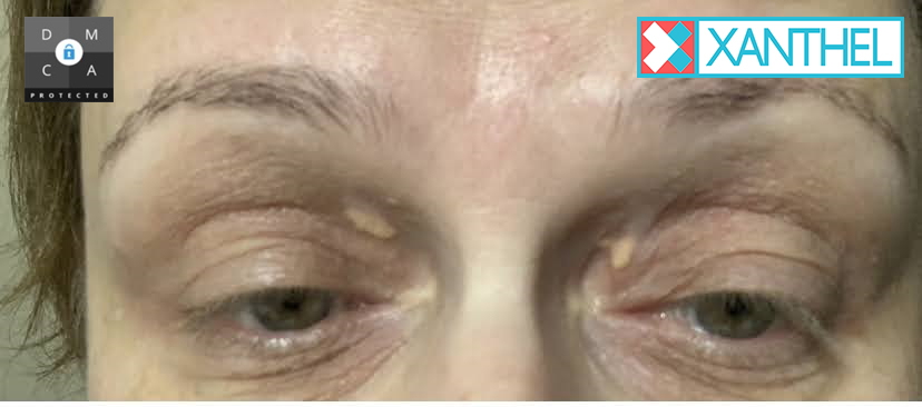xanthelasma removal 3