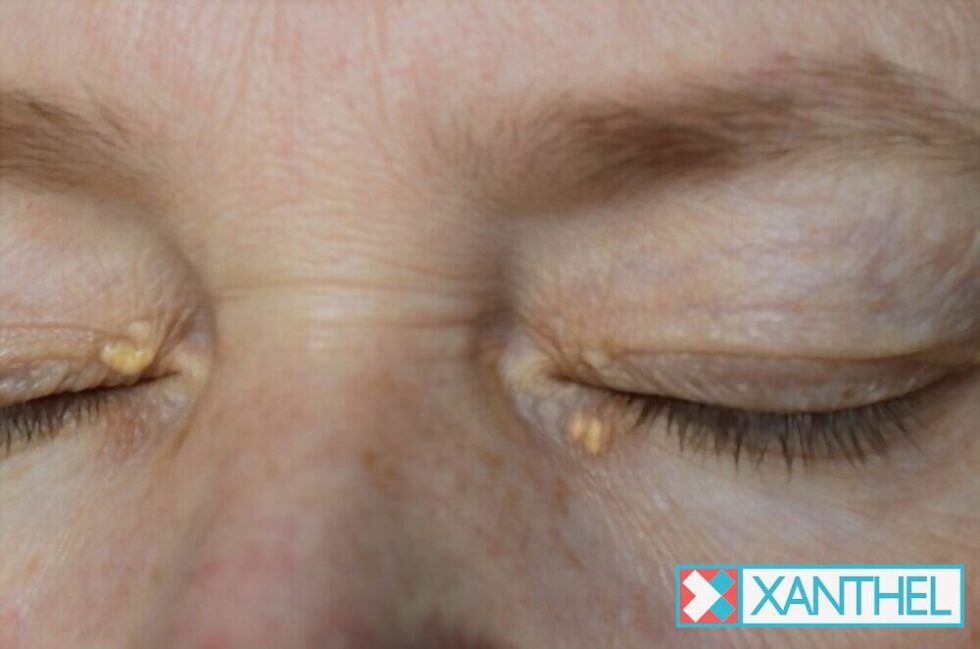 Ooglid Xanthomas Xanthelasma Behandeling
