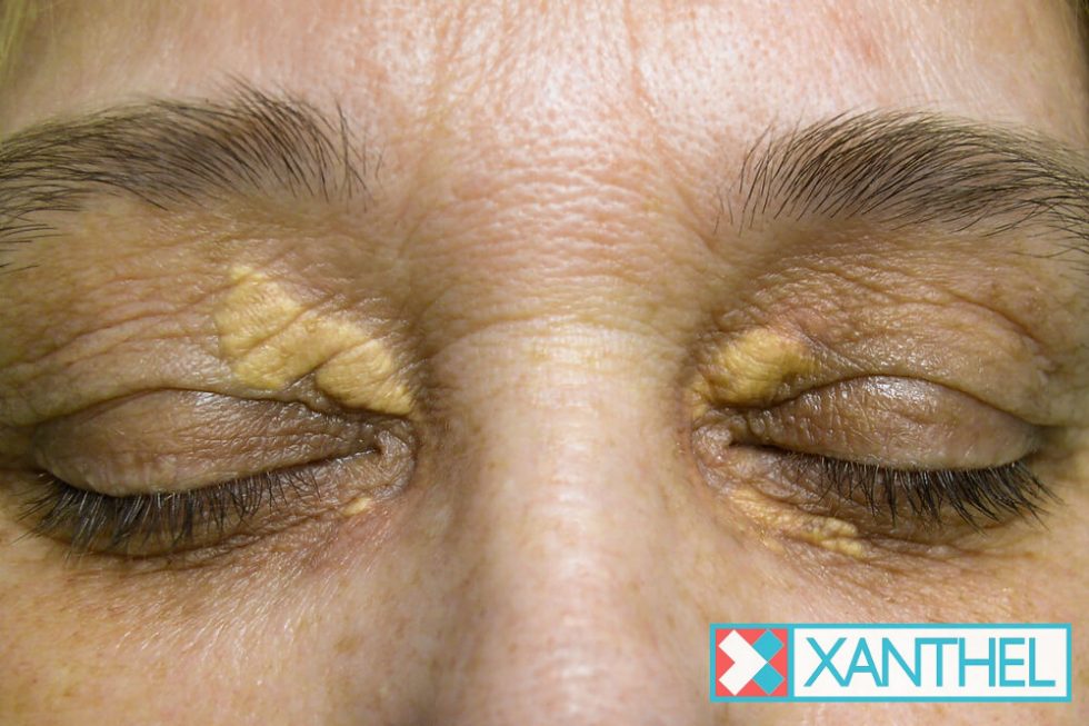 Xanthelasma Removal Cream Xanthel
