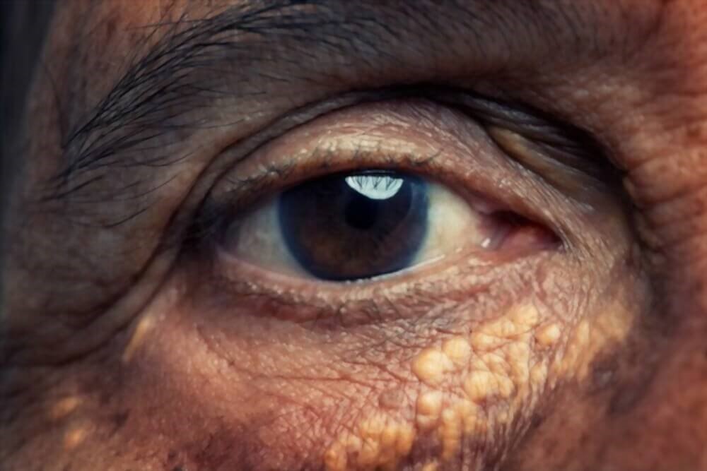 Cholesterol deposits on the eyelid