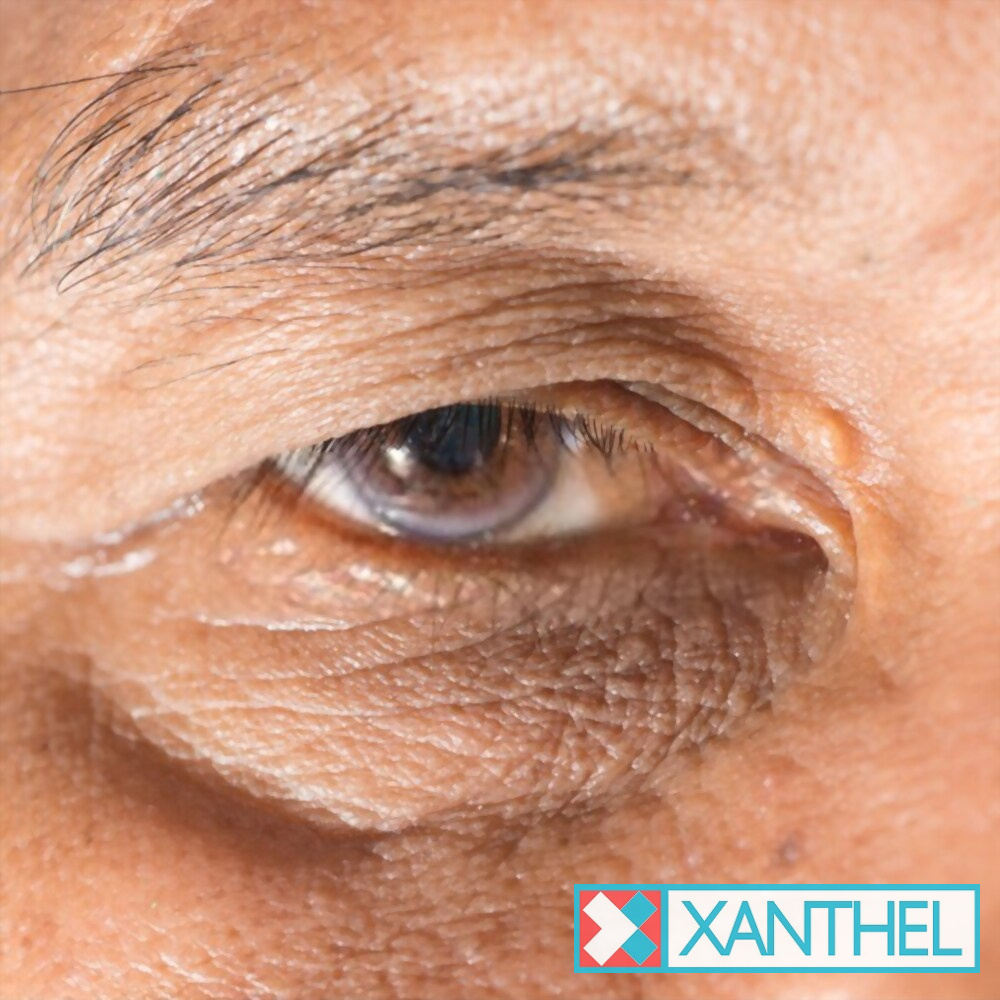 A small xanthelasma patch near the eye