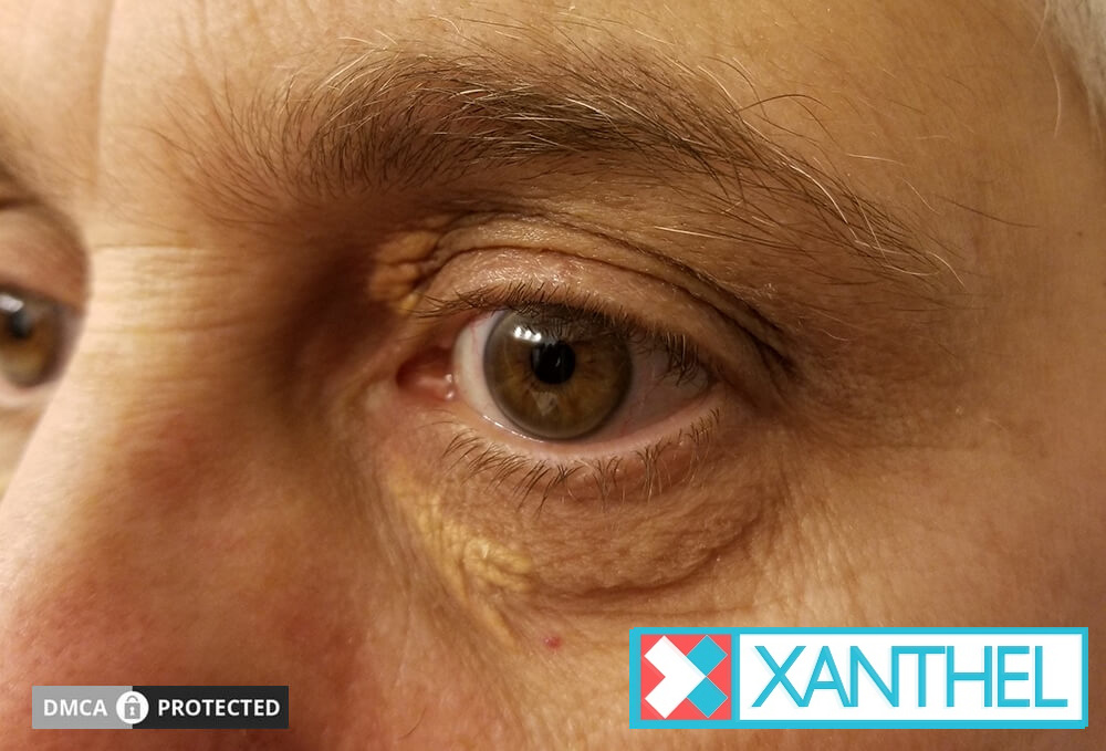 What xanthelasma looks like on the eyelids