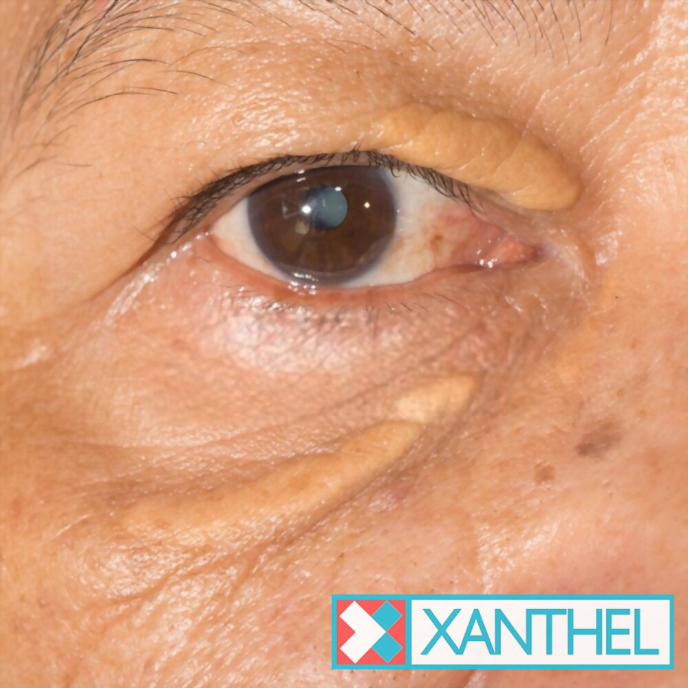Yellow xanthelasma patches on the eyelid