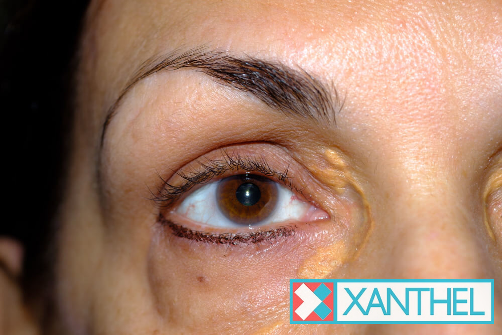 Xanthelasma patches you could remove at home