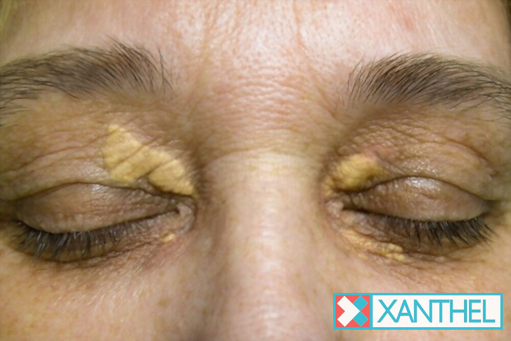 Xanthelasma palpebrarum on the eyelids