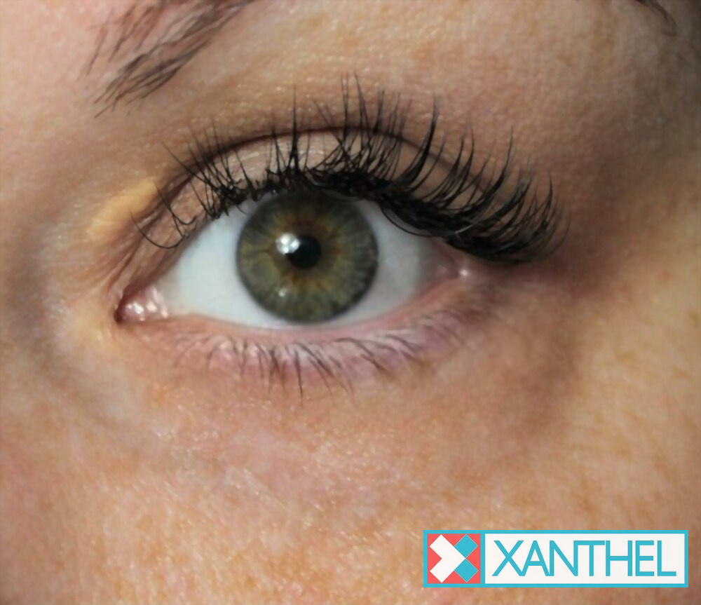 Xanthoma deposits around the eye