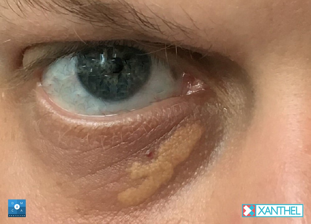 Xanthelasma under the eyes