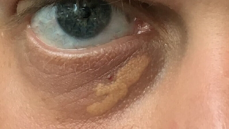 cara menghilangkan xanthelasma secara semulajadi