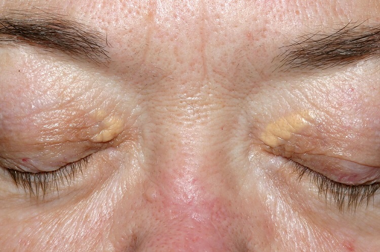 natural ways to clear up xanthelasma