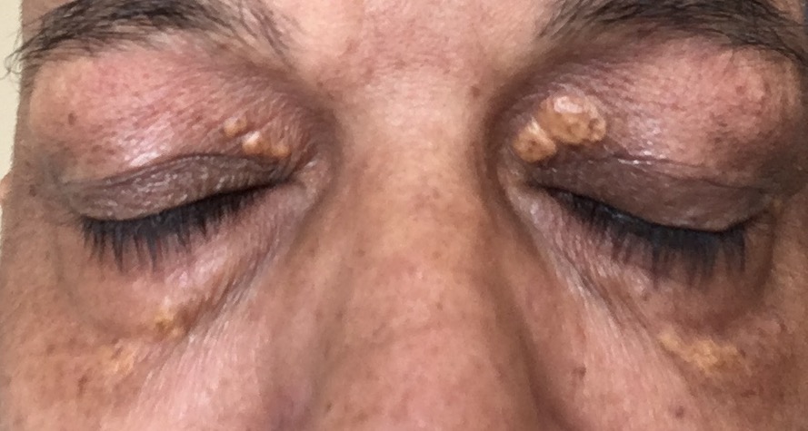 menggunakan ubat semula jadi untuk menghilangkan xanthelasma