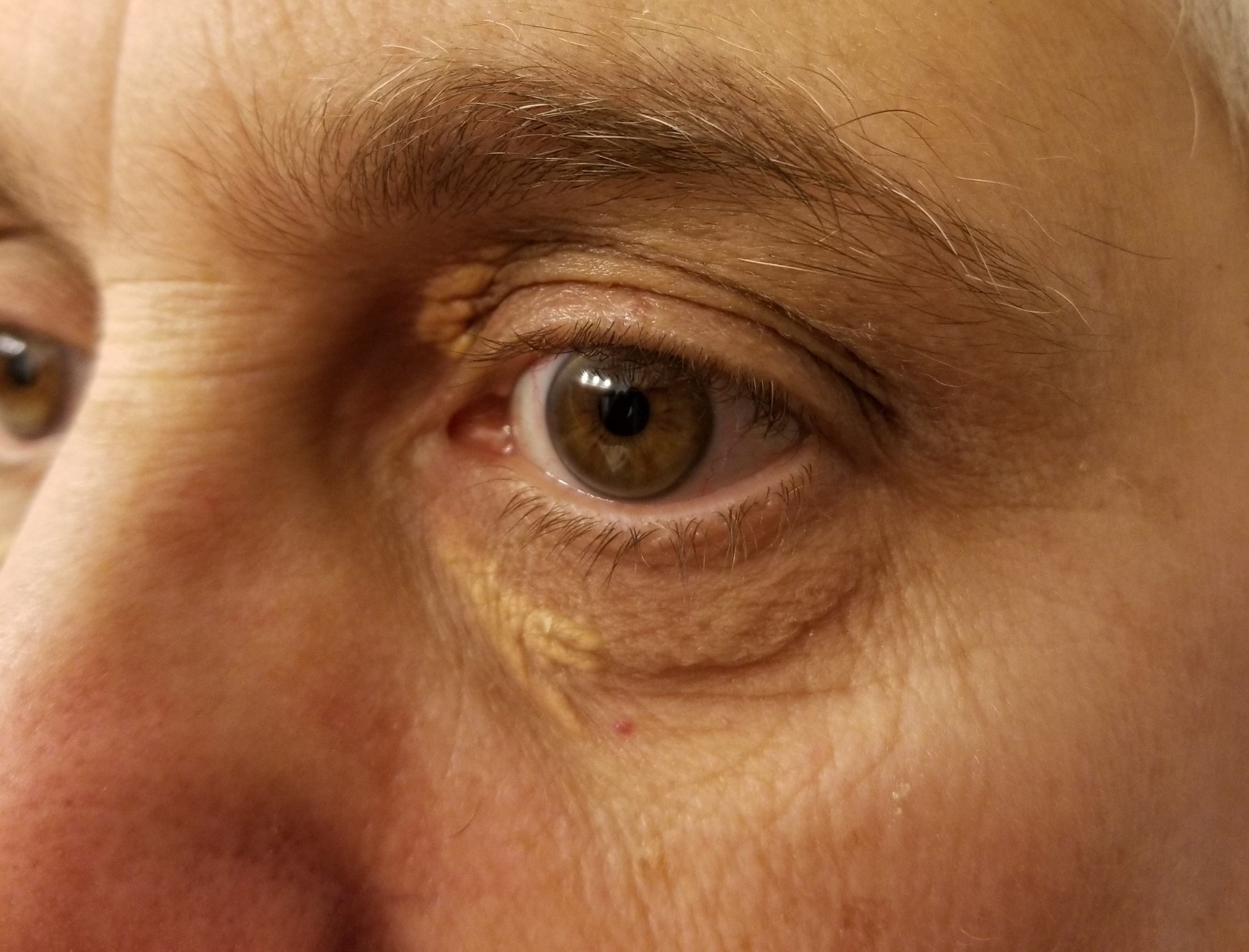 xanthelasma di bawah mata